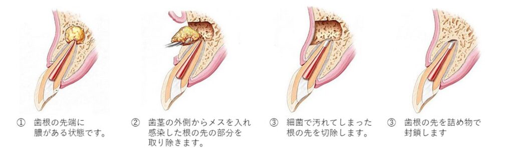 歯根端切除術の説明図